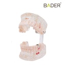 MODELO DENTAL TRANSPARENTE IMPLANTE