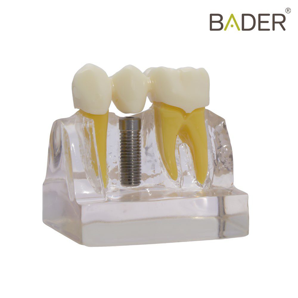 MODELO DE DEMOSTRACIÓN DE IMPLANTES