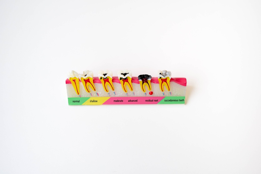 MODELO PROGRESIÓN DE CARIES