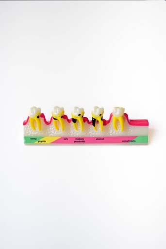 [0905140] MODELO PROGRESIÓN DE ENFERMEDAD PERIODONTAL